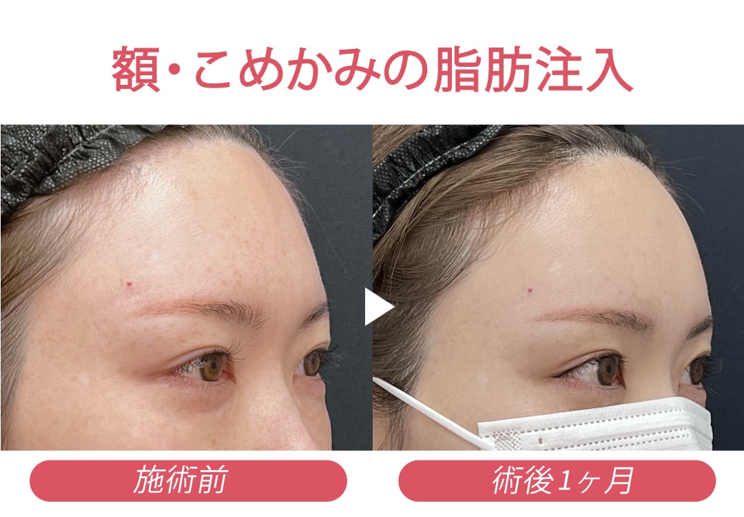 額・こめかみの脂肪注入