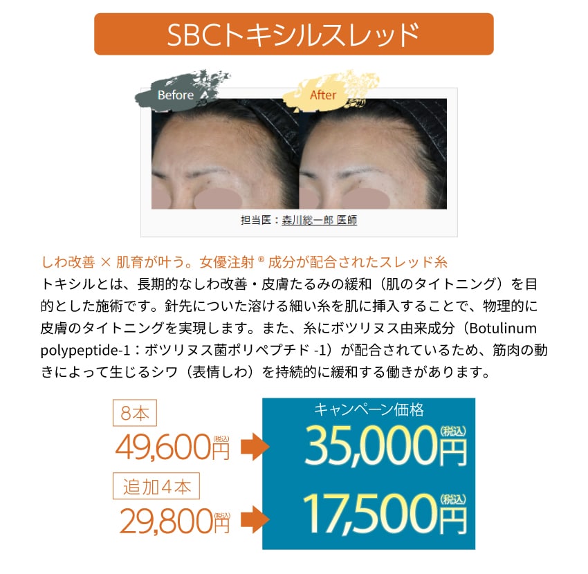 SBCトキシルスレッド