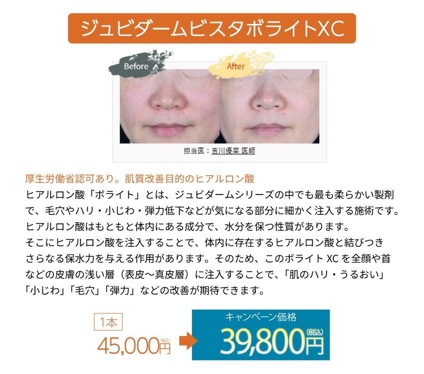 ジュビダームビスタボライトXC