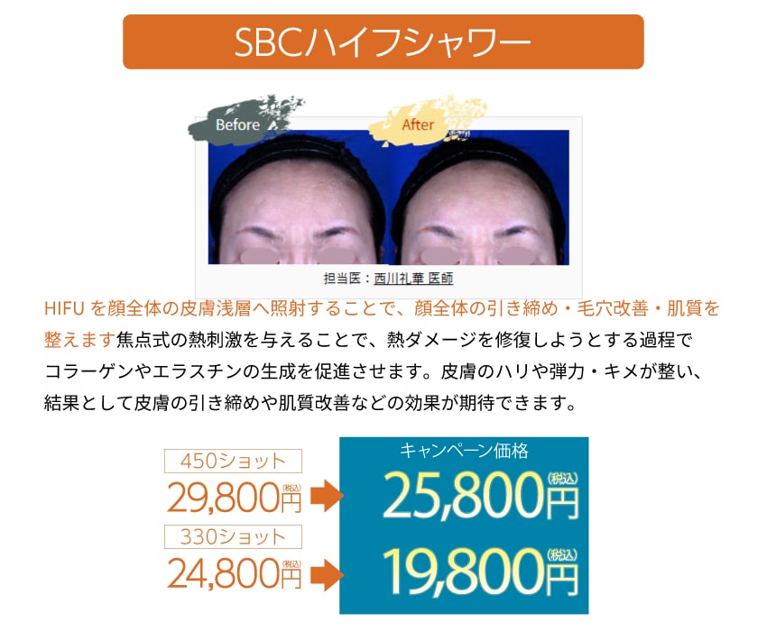 SBCハイフシャワー