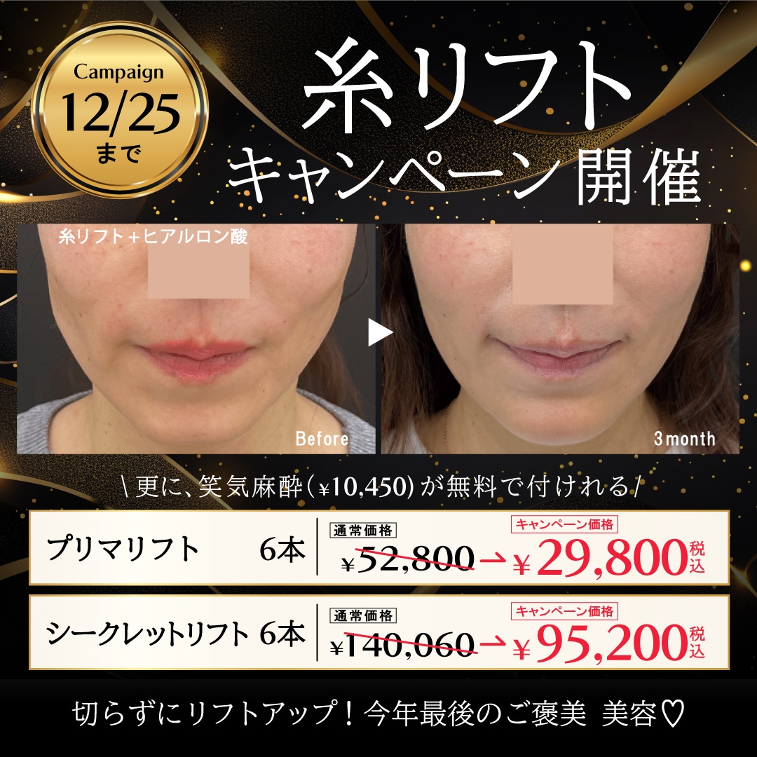 糸リフトキャンペーン