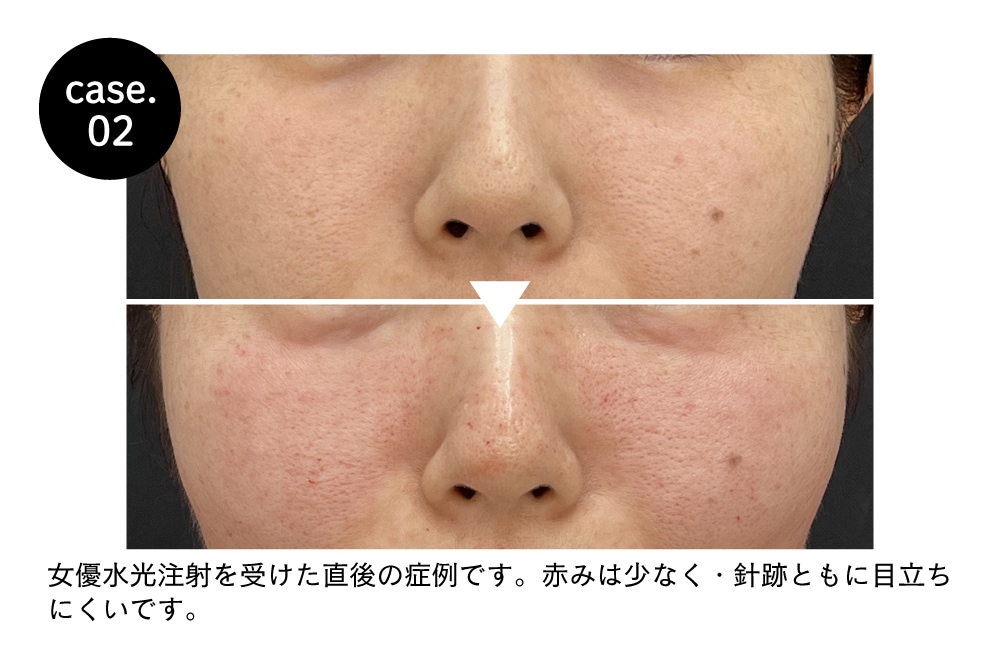 水光注射（女優/ジュベルック）】大阪江坂院でうるツヤ美肌を叶える