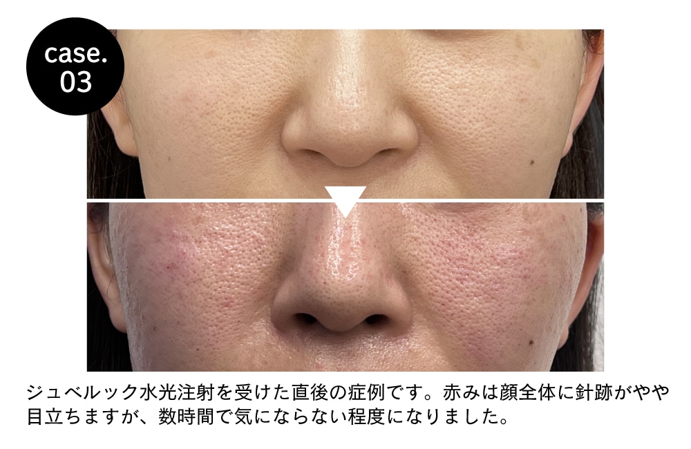 水光注射 水光注射（女優/ジュベルック）】大阪江坂院でうるツヤ美肌を叶える