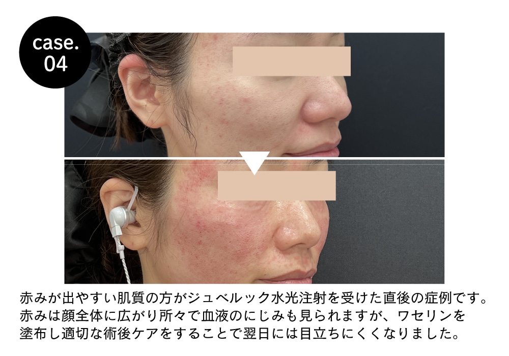 水光注射（女優/ジュベルック）】大阪江坂院でうるツヤ美肌を叶える