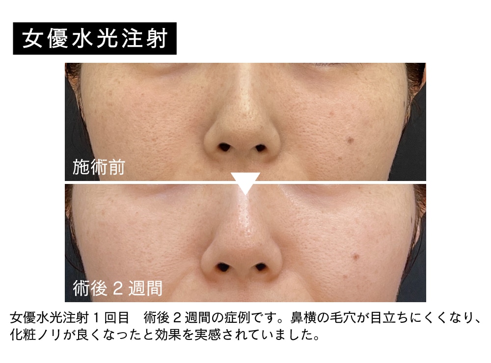 水光注射 水光注射（女優/ジュベルック）】大阪江坂院でうるツヤ美肌を叶える