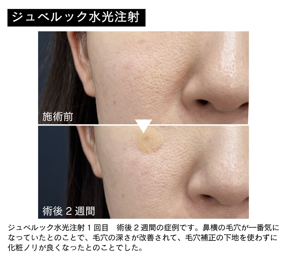 水光注射（女優/ジュベルック）】大阪江坂院でうるツヤ美肌を叶える