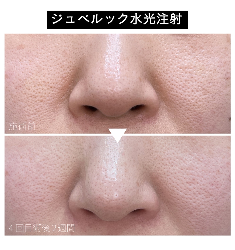 水光注射（女優/ジュベルック）】大阪江坂院でうるツヤ美肌を叶える