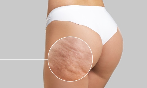 ボコ付きのリスクを軽減