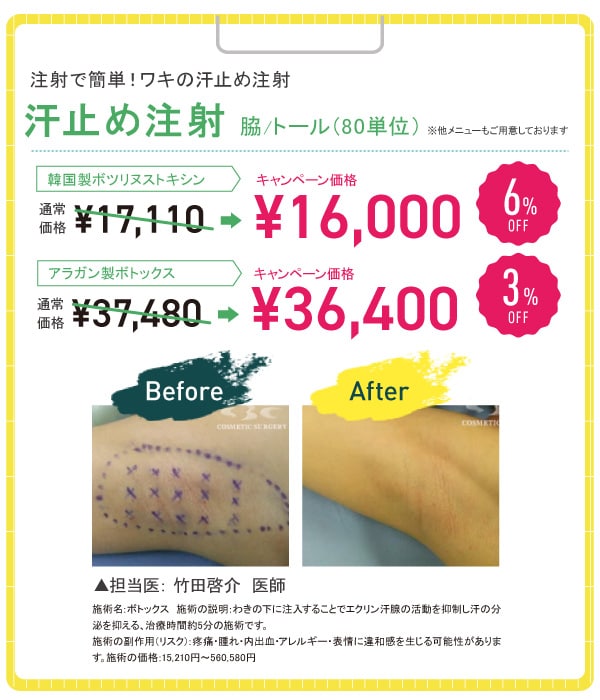 ワキボトックス 6%OFF