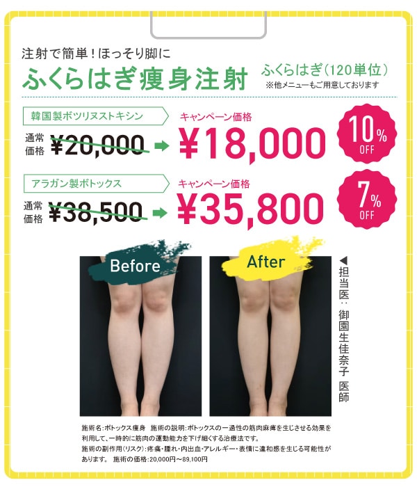 ふくらはぎボトックス 10%OFF