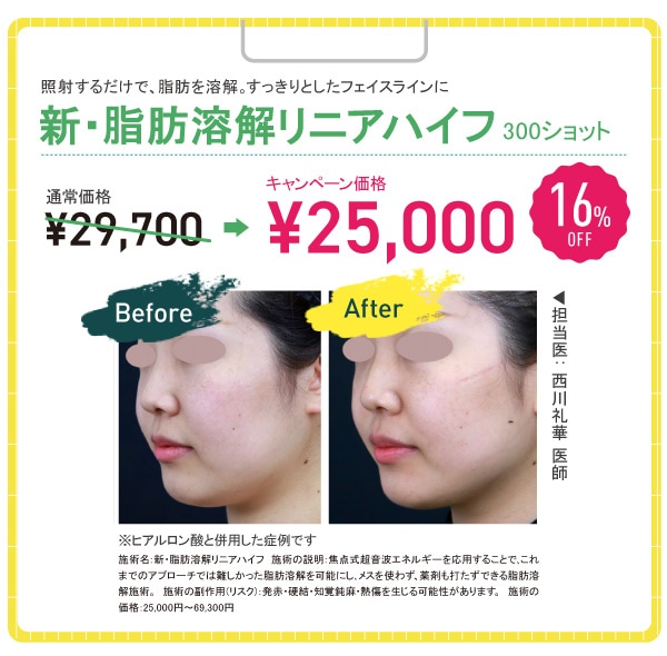 脂肪溶解リニアハイフ 16%OFF