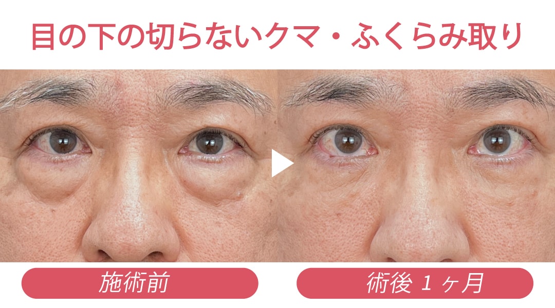 目の下の切らないクマ・ふくらみ取り