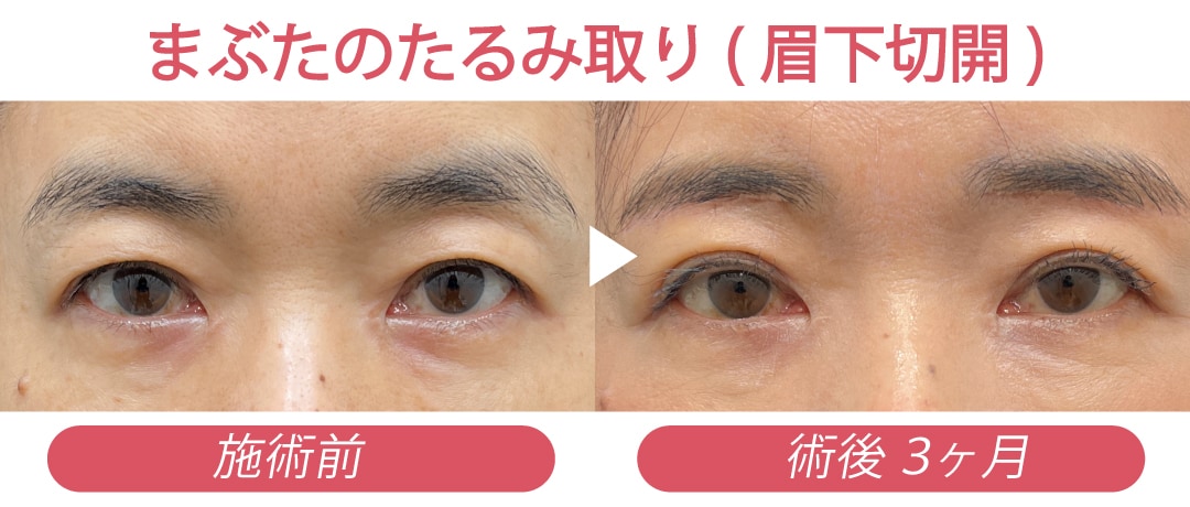 眉下切開（眉下リフト）