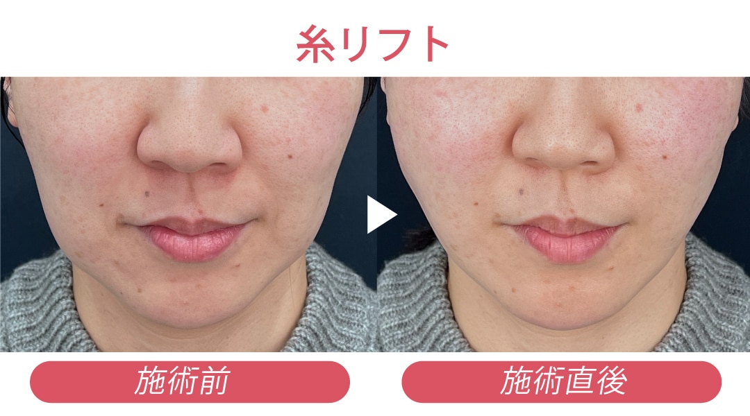 武田院長の似合わせ糸リフト