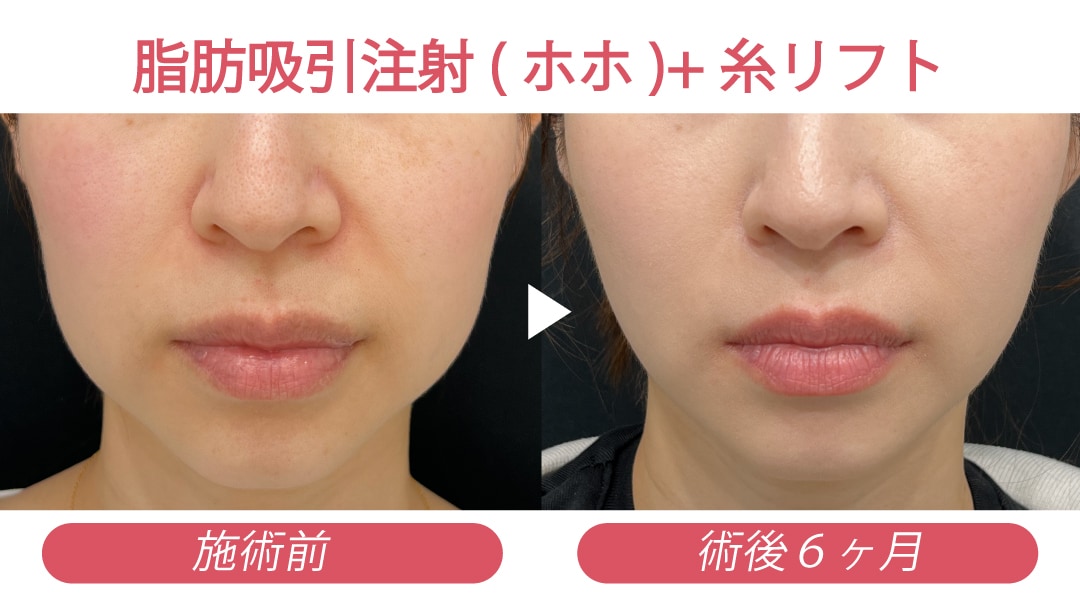 美ボディ脂肪吸引・脂肪吸引注射