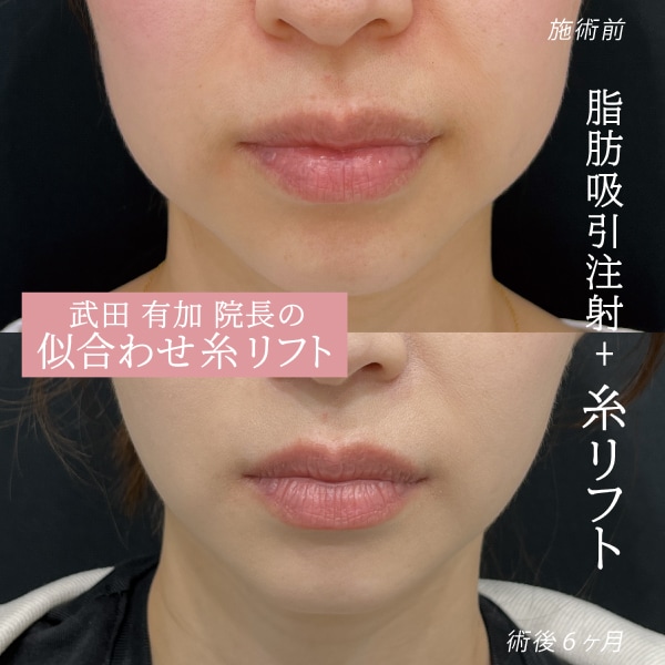 脂肪吸引注射