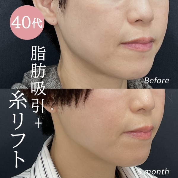 美ボディ脂肪吸引