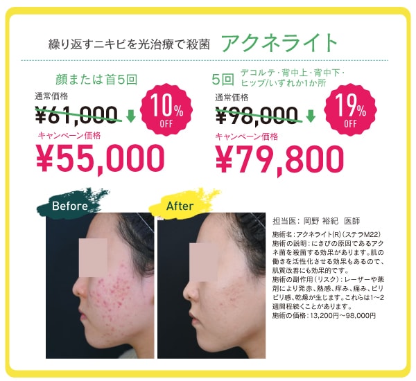アクネライト