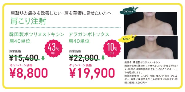 肩ボトックス