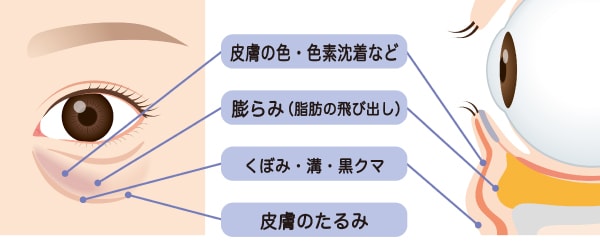 クマ取り治療（経結膜脱脂術）について詳しく