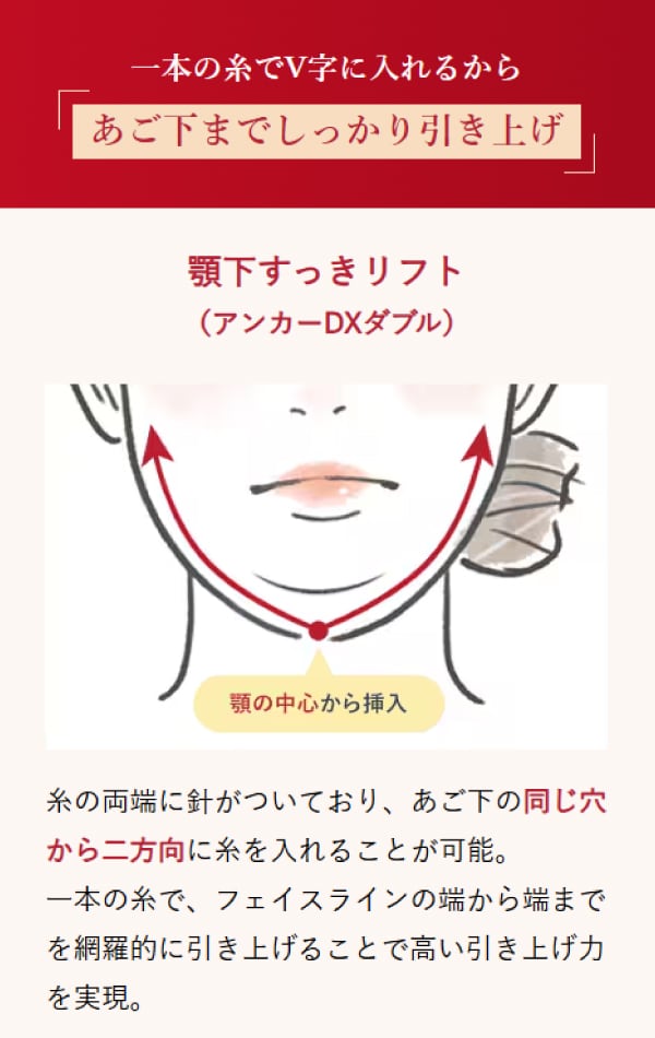 アンカーDXダブル説明