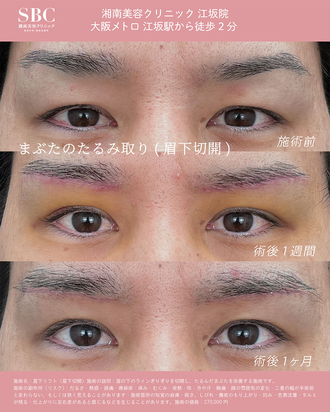 眉下切開症例①