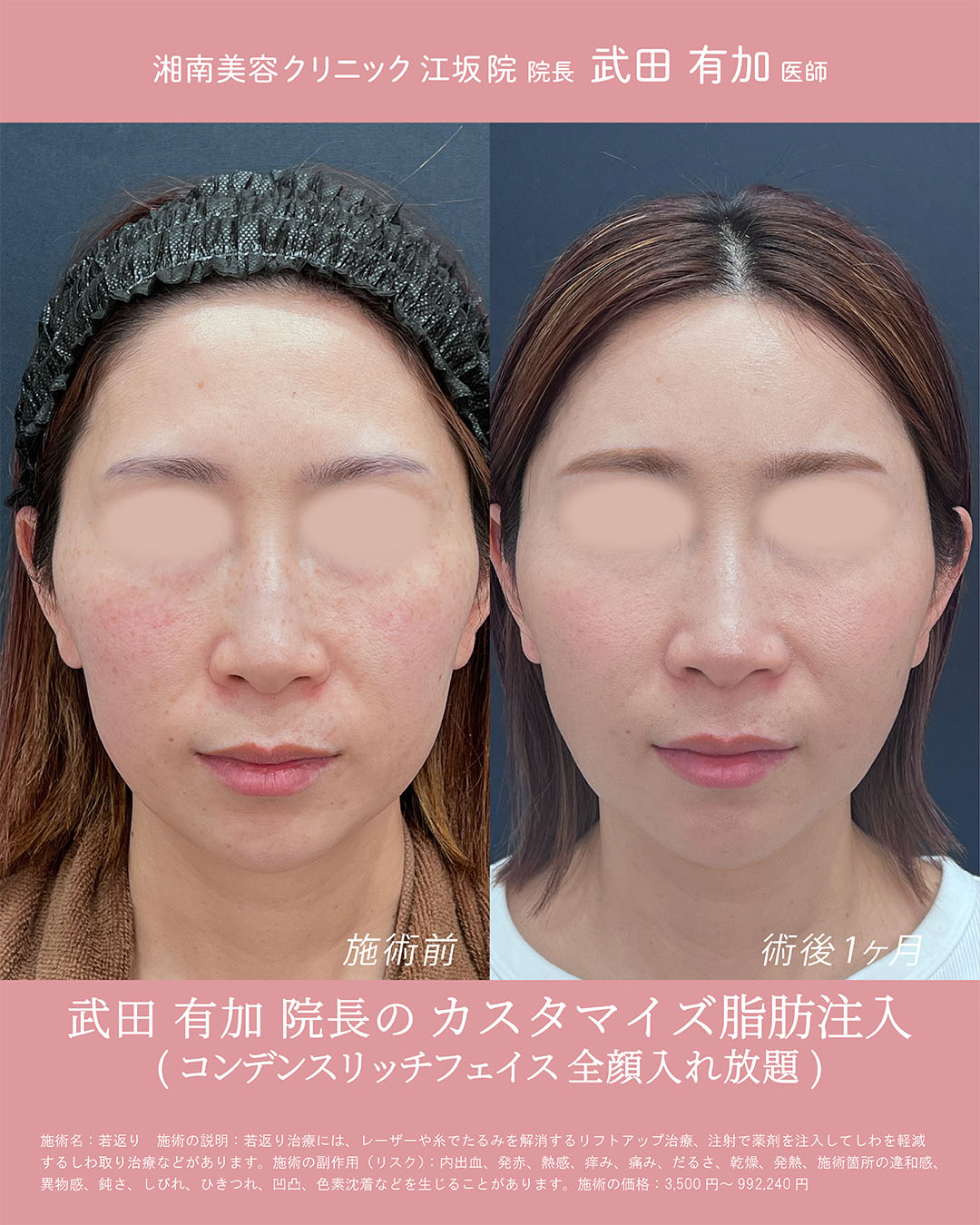 顔の脂肪注入し放題症例①