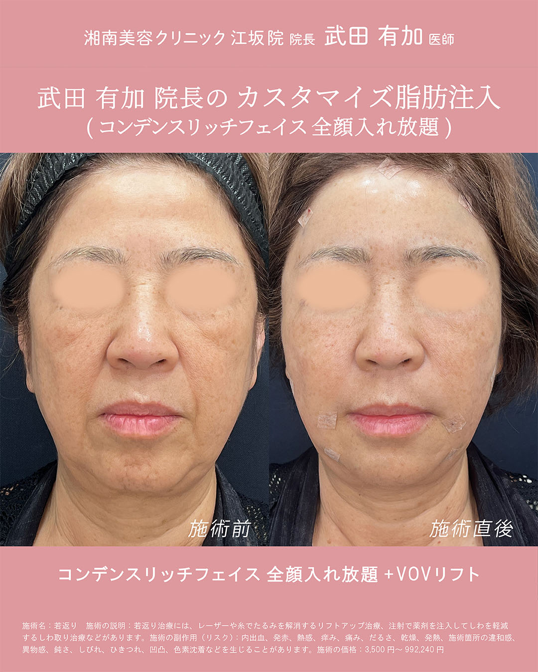 糸リフト症例②