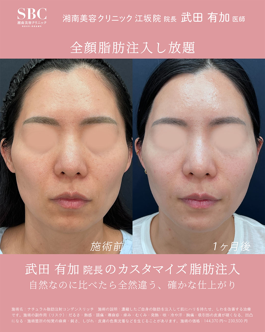 顔の脂肪注入し放題症例②