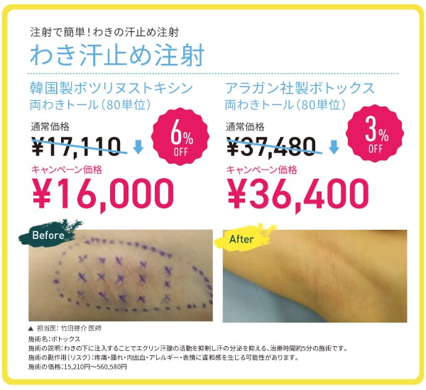 わき汗止め注射 MAX 6%OFF