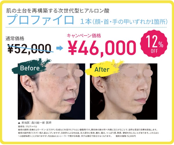 プロファイロ 12%OFF