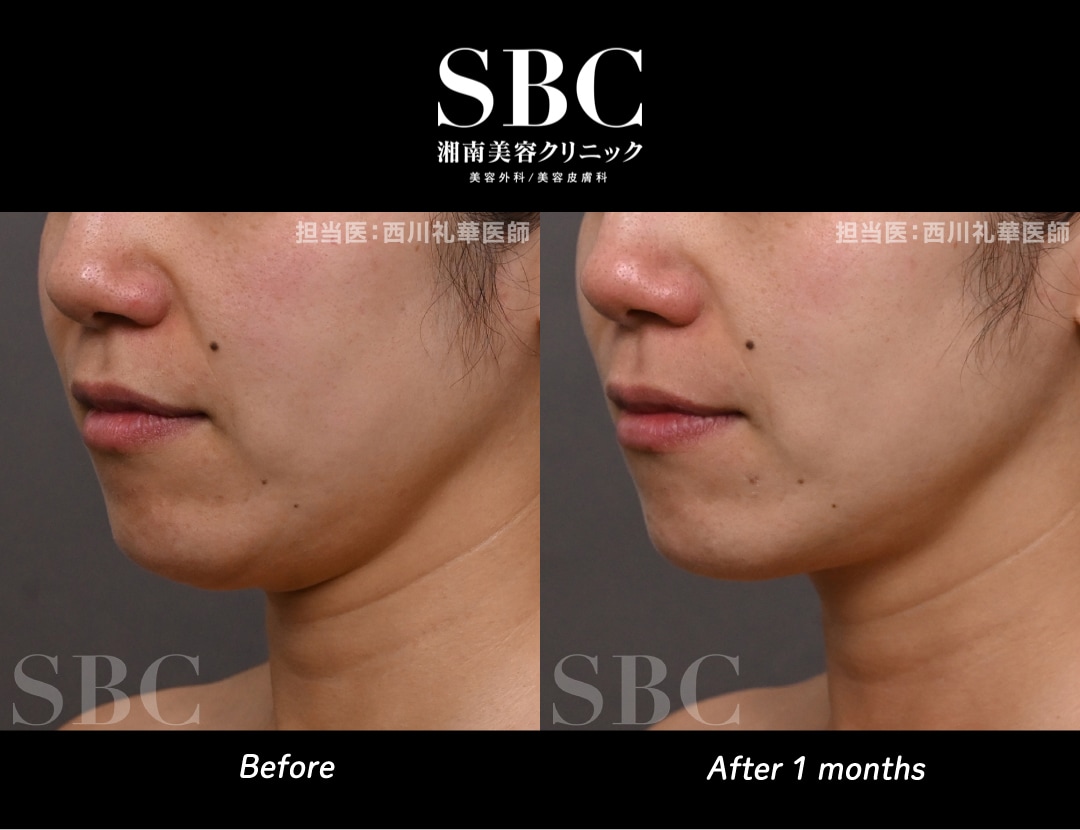 SBCハイフプログラム症例