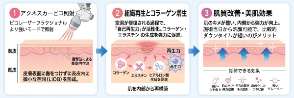 アクネスカーピコ