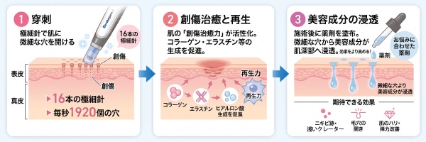 ダーマペン4