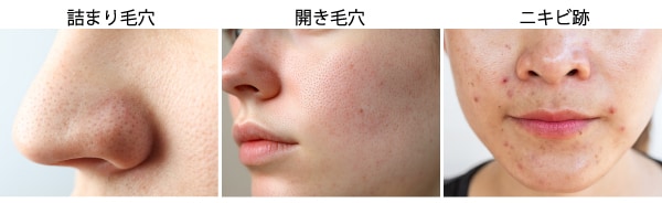 毛穴・ニキビ跡の種類と根本原因