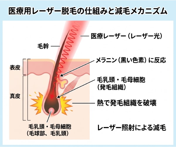 医療レーザー脱毛の仕組みと減毛メカニズム