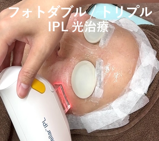 💡フォトダブル / フォトトリプル(IPL光治療)の効果