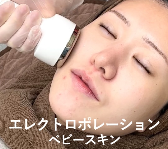 👶🏻 エレクトロポレーション（ベビースキン導入）の効果