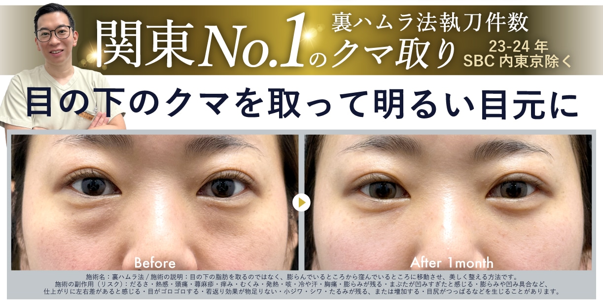年末年始おすすめ美容治療 ①<br />
✨クマ取り(裏ハムラ法)✨