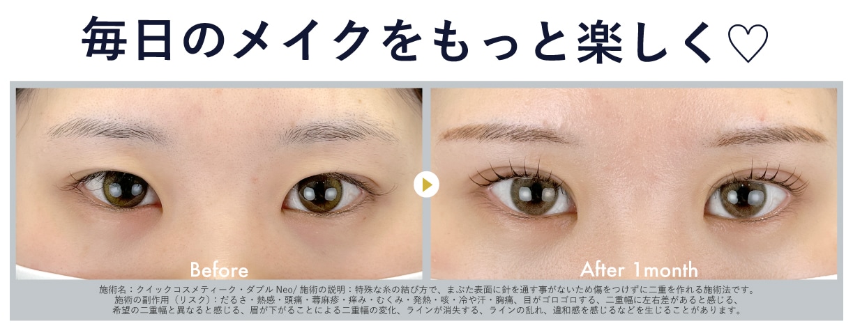 年末年始おすすめ美容治療 ②<br />
✨二重整形(埋没法)✨