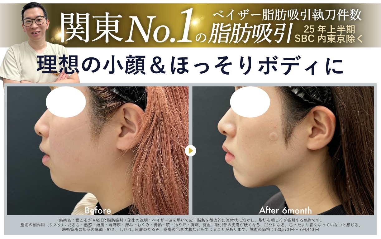 年末年始おすすめ美容治療 ③<br />
✨脂肪吸引✨