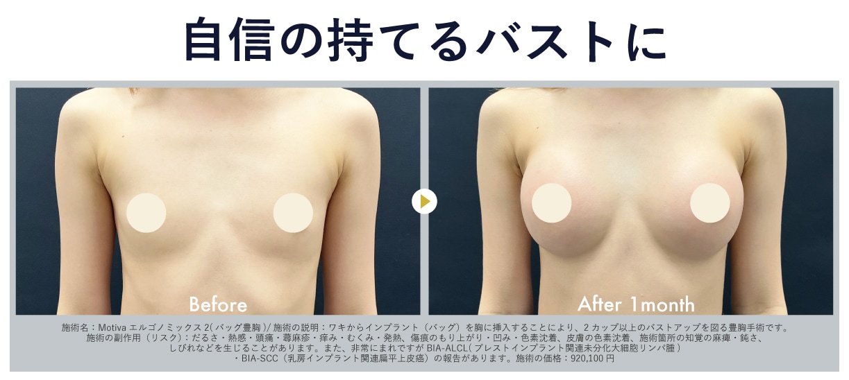 年末年始おすすめ美容治療 ④<br />
✨豊胸術✨