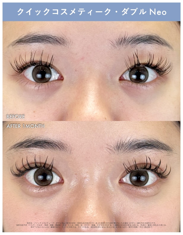 クイックコスメティークダブルNeo１ヶ月後の症例