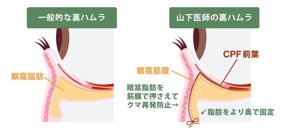 再発を許さない「隔膜強化×深層固定メソッド」