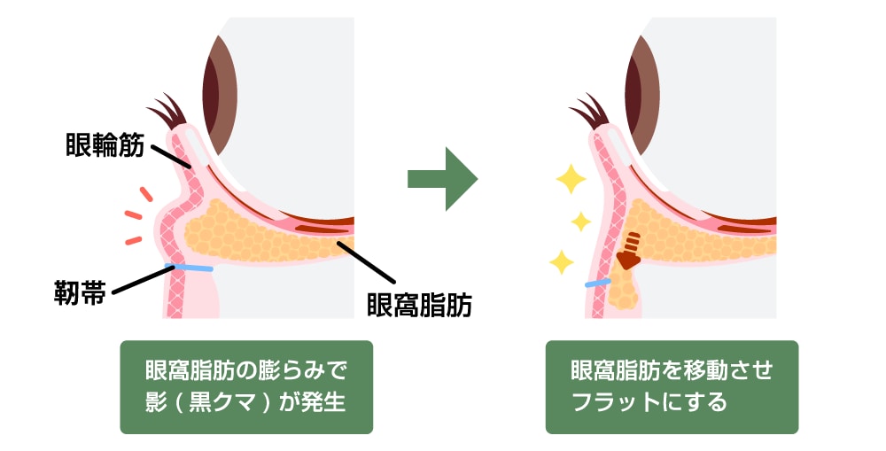 クマを改善するなら