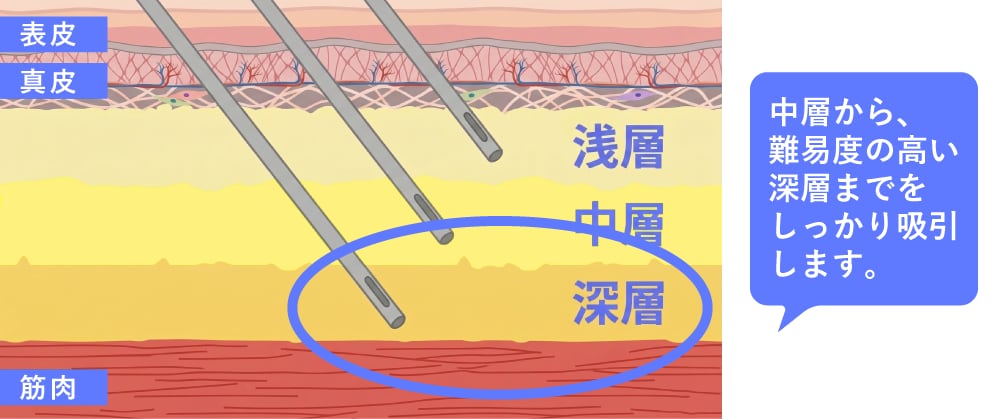 「深い層」を徹底的に吸引し、適切なサイズダウンを