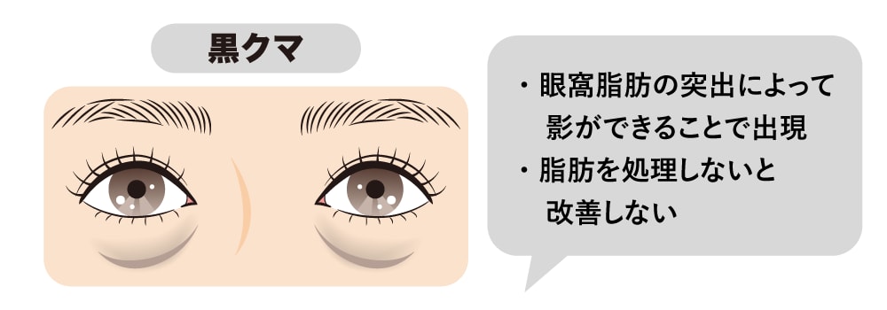 「黒クマ」：脂肪の膨らみとたるみが原因