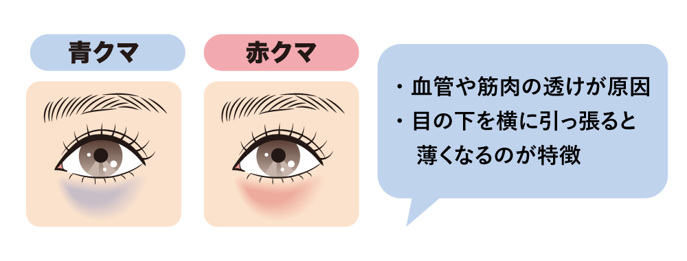 「青・赤クマ」：血行不良や皮膚の薄さが原因