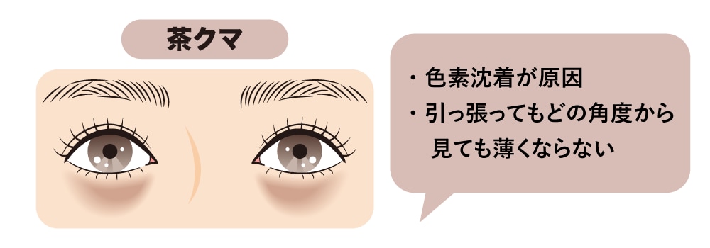 「茶クマ」：摩擦や乾燥による色素沈着が原因