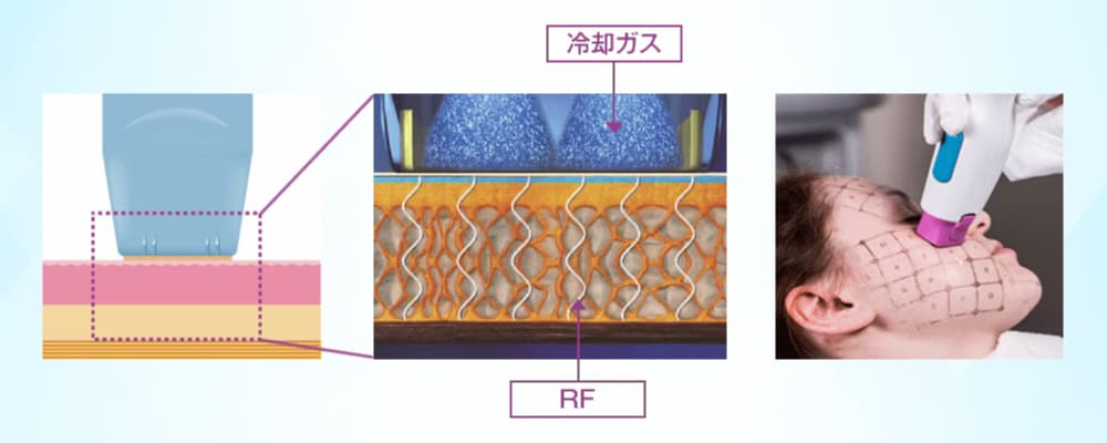切らない、怖くない。高周波（RF）で叶える「根本引き締め」